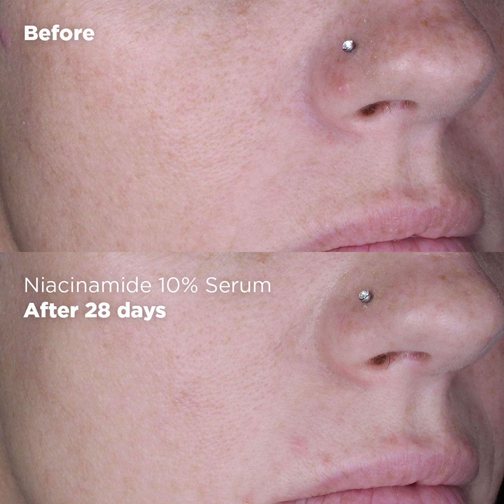 Niacinamide 10% + Zinc 1% serum