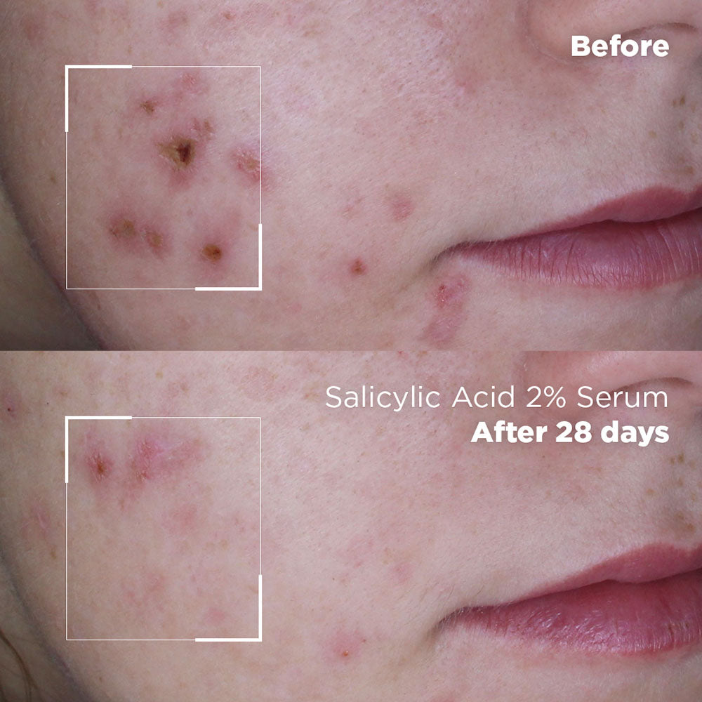 Salicylic Acid 2% Serum